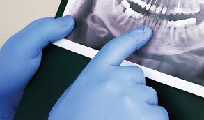 بهترین مراکز عکس OPG دندان و راهنمای هزینه های عکس برداری OPG