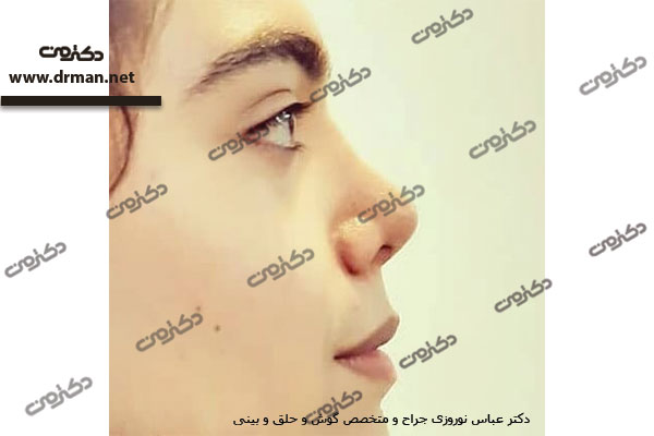 دکتر عباس نوروزی جراح بینی در کرج